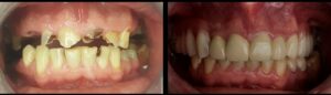 Implanty wstawianie zębów