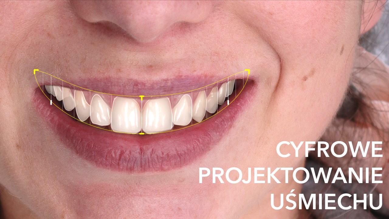 Cyfrowe biblioteki naturalnych zębów umożliwiają nam precyzyjne zaprojektowanie i wykonanie dla Ciebie uśmiechu skrojonego na miarę.​