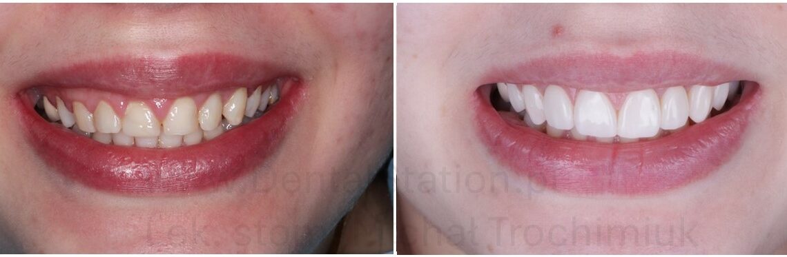 Bonding zębów Warszawa gdzie najlepiej